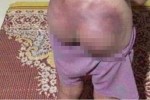 Ăn trộm 50.000 đồng, bé gái 12 tuổi bị công an đánh bầm tím mông