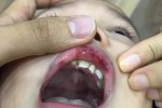 Đuổi việc cô giáo tát trẻ 3 tuổi bầm tím mặt, tụ máu môi