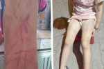 Phẫn nộ với hình ảnh bé gái 6 tuổi bị đánh đập bầm dập khắp người