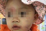 Bé gái 14 tháng tuổi bị thương sau giờ học ở lớp mầm non do bạn cắn