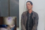 Nóng trên mạng xã hội: Bé Su thương tích 51%: Rùng mình những lần bị 'ba Việt' chích thuốc lá vào háng, vùng kín