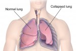 Bệnh nhân phi công Anh "rất nguy kịch"