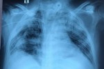 Bệnh nhân phi công giảm dần thông số ECMO